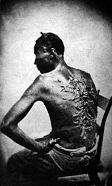 Cicatrices de flagellation